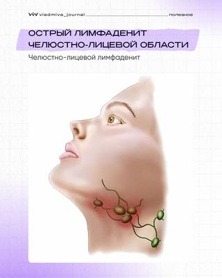Лимфаденит: острые формы в практике стоматолога.